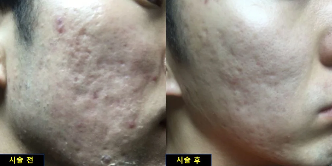 Acne scars — before & after comparison photo