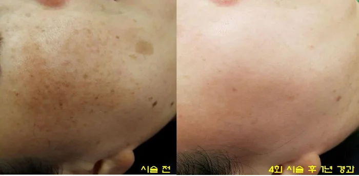 Melasma — before & after 4 sessions comparison photo