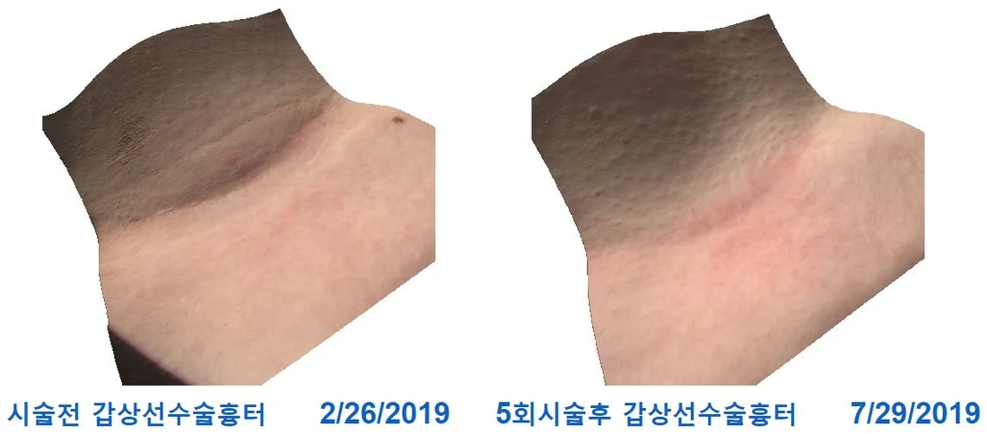 Thyroid surgery scar — before & after 5 sessions comparison photo